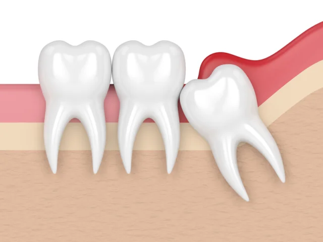 Viêm lợi trùm răng khôn cần điều trị thế nào?