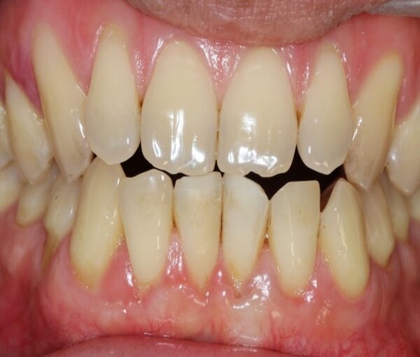 Khớp cắn đối đầu có thể gây ra nhiều ảnh hưởng nếu không được điều trị sớm
