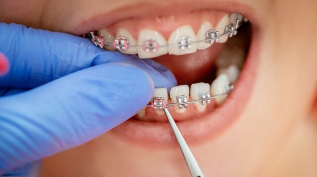 Niềng răng là một trong những giải pháp khắc phục sai khớp cắn tốt hiện nay