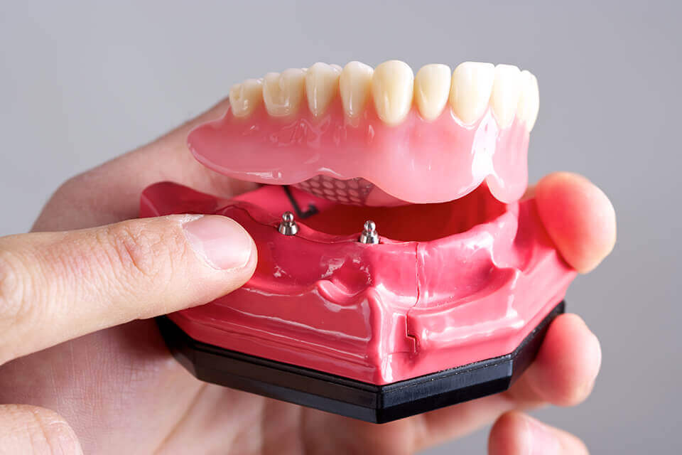ham-thao-lap-tren-implant-hay-ham-truyen-thong-1