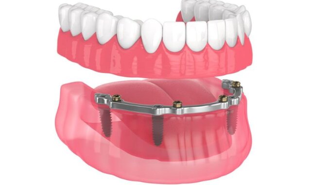 Hàm tháo lắp trên Implant có thanh bar