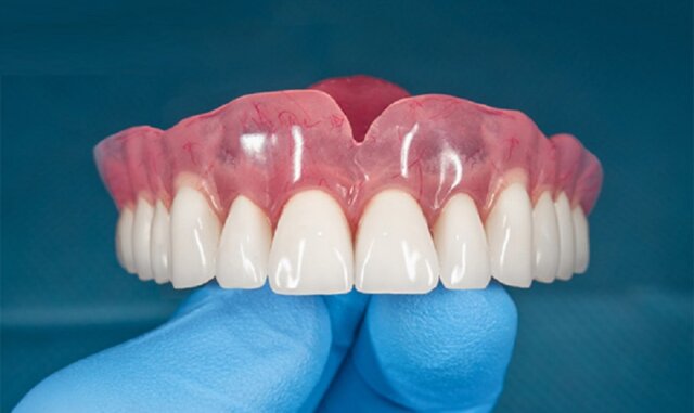 So sánh hàm tháo lắp trên Implant vs. hàm truyền thống