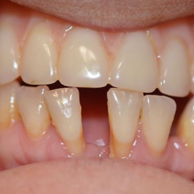 Răng thưa là một trong những tình trạng có thể xem xét đến phương pháp niềng răng