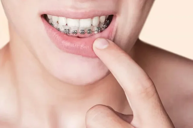 Những điều cần lưu ý khi niềng răng 1 hàm dưới