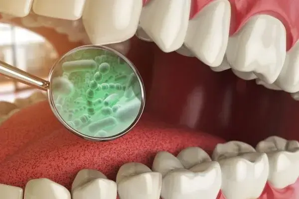 Quá trình vi khuẩn tấn công răng diễn ra như thế nào?