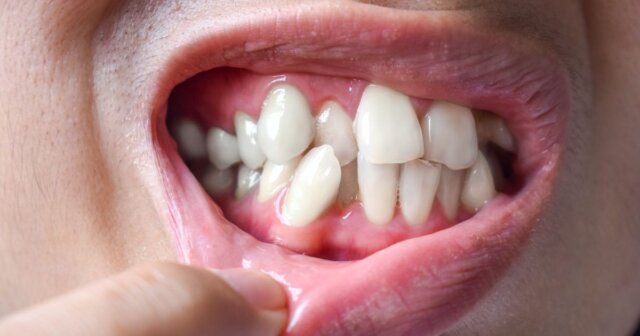 Nắm bắt nguyên nhân răng mọc lộn xộn