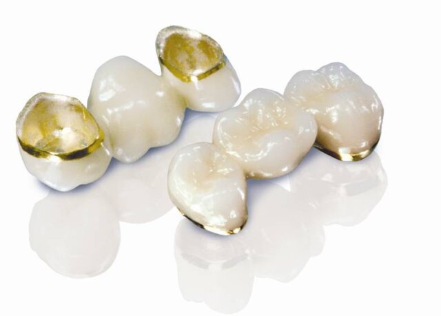 Răng sứ kim loại quý có nhiều ưu điểm nổi bật