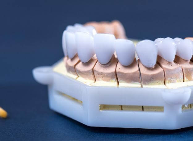 Có nên lựa chọn bọc sứ cho toàn bộ hàm không?