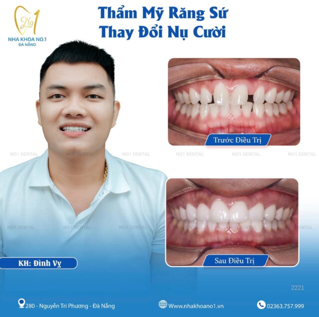 Thẩm mỹ răng sứ - Thay đổi nụ cười
