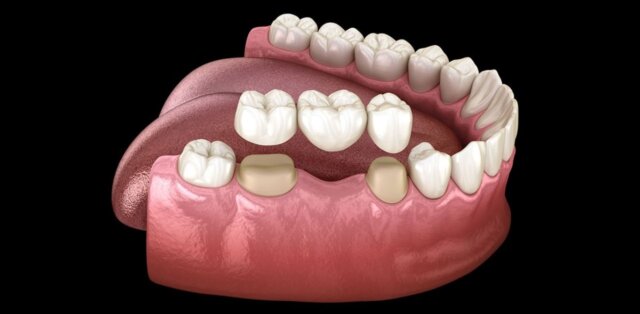 Làm cầu răng sứ tái tạo răng số 6 bị mất