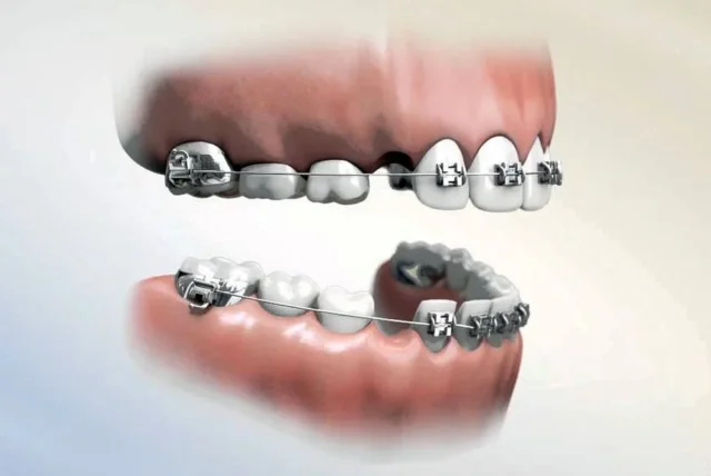 Trường hợp nào cần nhổ răng để thuận lợi chỉnh nha?