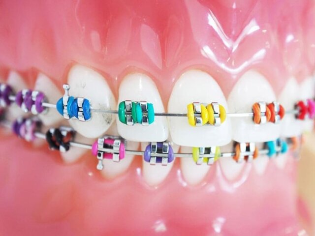 TRUNG TÂM NHA KHOA CUNG CẤP DỊCH VỤ NIỀNG RĂNG CHẤT LƯỢNG TẠI THÀNH PHỐ ĐÀ NẴNG