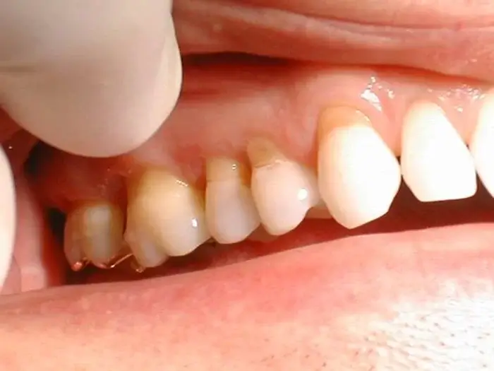 Tác động của tụt lợi chân răng với sức khỏe răng miệng