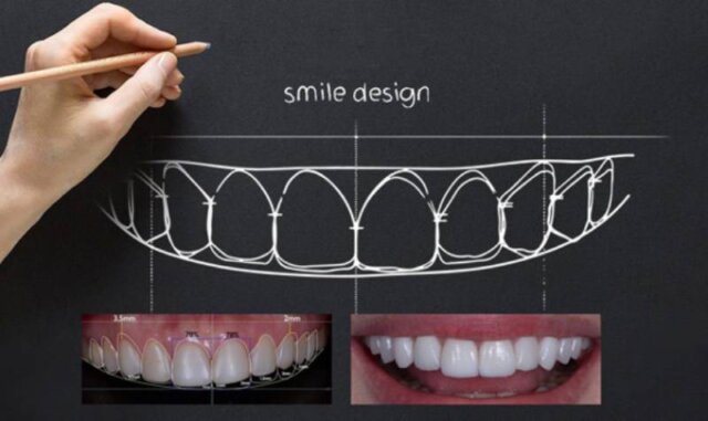 Thiết kế thẩm mỹ nụ cười là gì?