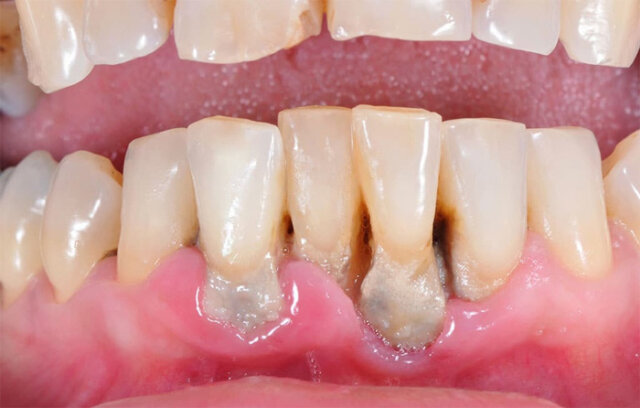 Làm cách nào để nhận biết viêm nha chu mức độ nặng?