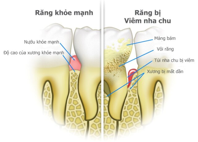 Do đâu gây ra tình trạng viêm nha chu?