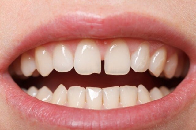 Răng thưa hoặc lệch lạc mức độ nhẹ có thể chọn khắc phục bằng bọc răng sứ 