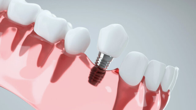 Cấy Implant có thể mang lại nhiều lợi ích tuyệt vời cho thẩm mỹ gương mặt