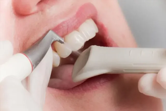 Ứng dụng thổi cát răng trong nha khoa có rất nhiều điểm nổi bật