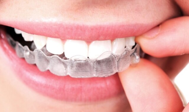 Niềng răng trong suốt có nhất thiết phải nhổ răng không?
