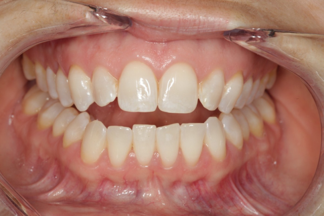 Hiện nay có nhiều cách để khắc phục ảnh hưởng và thay đổi tật đẩy lưỡi