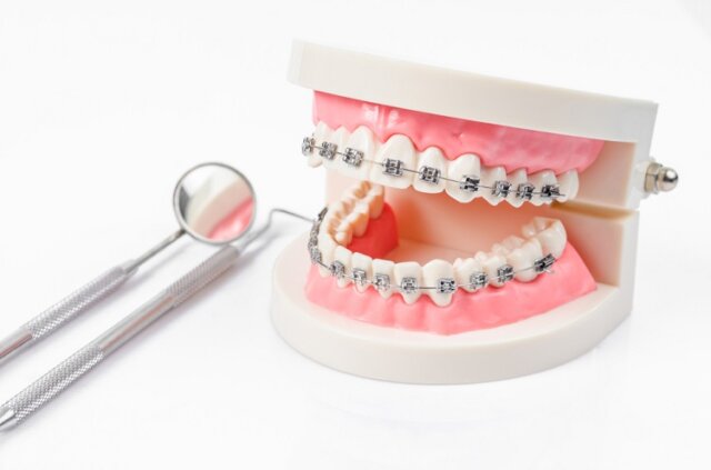 Thở bằng đường miệng có ảnh hưởng gì đến quá trình chỉnh nha không?