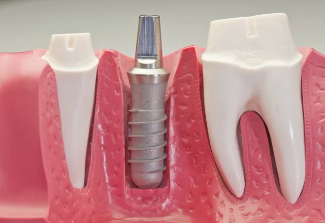 Cấy ghép Implant có những ưu, nhược điểm gì trong điều trị răng thưa