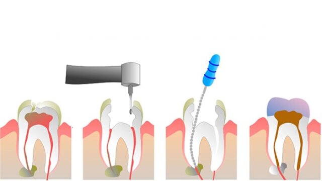 Khi nào cần thiết và không cần loại bỏ tủy trong quá trình trám răng?