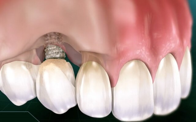 Nhờ quảng cáo hấp dẫn về giá cả phải chăng, trồng implant giá rẻ dễ thu hút nhiều người sử dụng