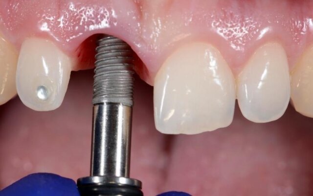 Trồng Implant kém chất lượng tiềm ẩn nhiều rủi ro