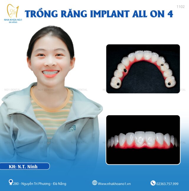 Cấy ghép Implant tại Nha khoa No1 Đà Nẵng - Giải pháp đáng tín cậy cho người mất răng