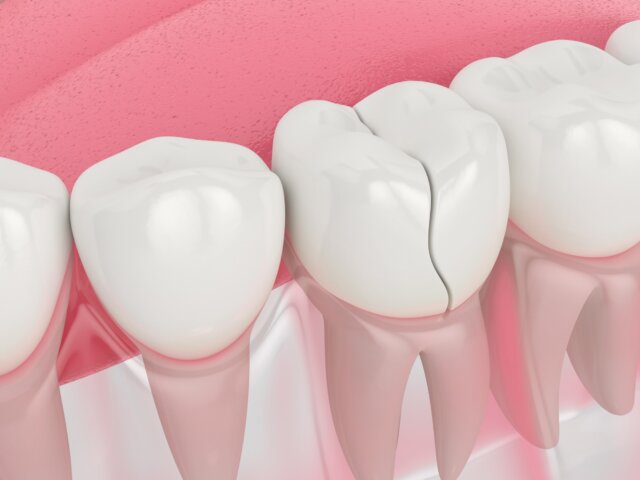 Những tác động có thể xảy ra khi răng sứ hư hỏng