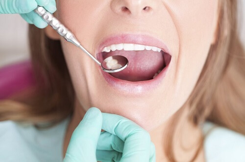 Trám răng mang đến nhiều lợi ích mà bạn nên biết