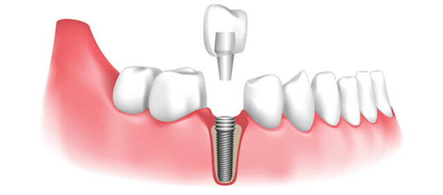 Răng bị mất ở điều kiện thuận lợi có thể lựa chọn trồng Implant để phục hồi