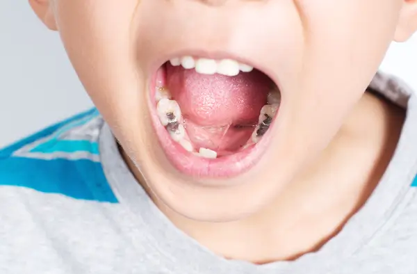 Hiểu về nguy cơ sâu răng ở trẻ để có chế độ chăm sóc răng miệng khoa học