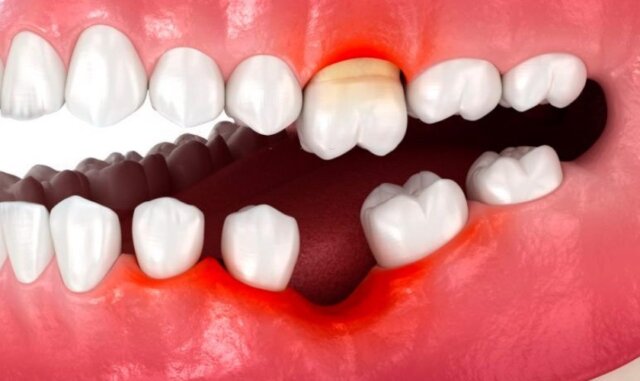 Răng bị mất xuất phát từ rất nhiều lý do khác nhau