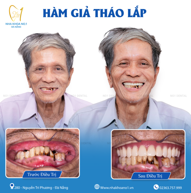 Tìm lại nụ cười tự tin ở tuổi xế chiều nhờ hàm giả tháo lắp