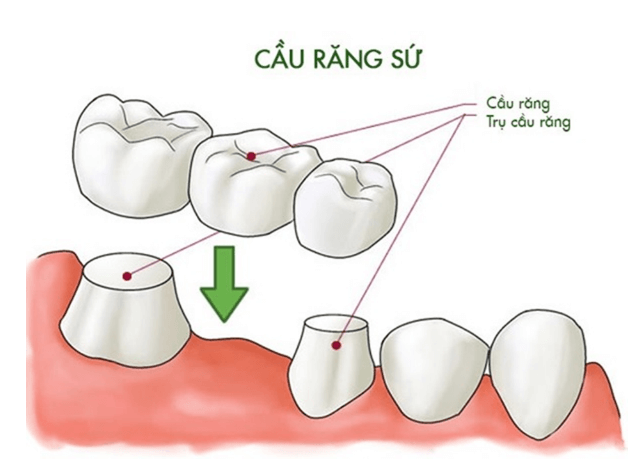 Cầu răng sứ là một trong những phương pháp phục hình cho răng bị mất, nhất là vị trí răng cửa