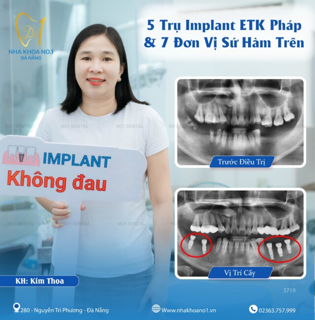 Hồi sinh răng mất nhờ cấy ghép Implant