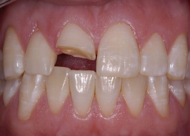 Những chiếc răng bị thương tổn mức độ phức tạp hơn có thể xem xét bọc sứ