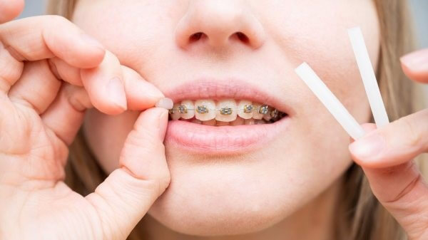 Hướng dẫn dùng sáp nha khoa đúng cách