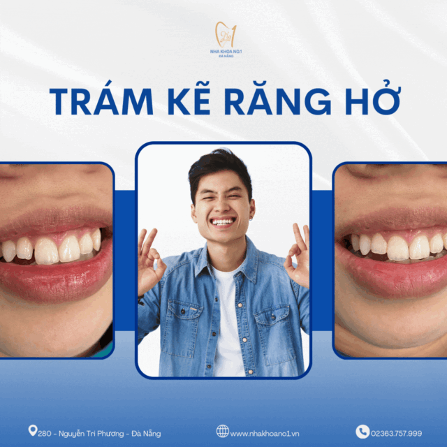 Phương pháp trám có thể phát huy tác dụng trong trám bít kẽ răng hở, thưa