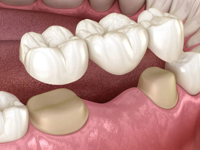 Trồng răng bằng cầu răng sứ là một trong những giải pháp khắc phục răng mất phổ biến hiện nay