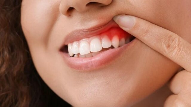 Làm thế nào để phát hiện nướu răng trong tình trạng kém?