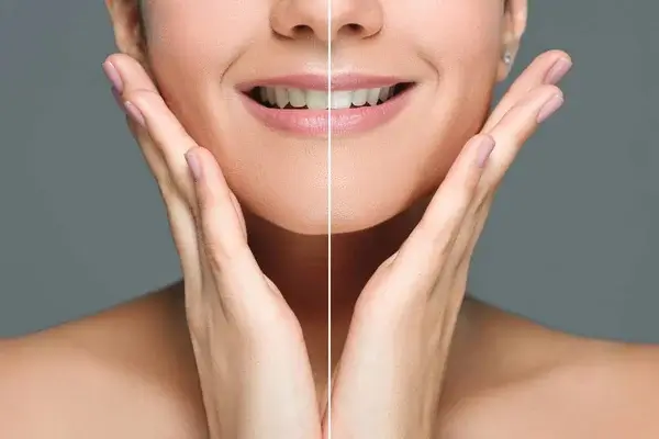 Thói quen nhai một bên gây ra nhiều tác động nếu không được khắc phục sớm