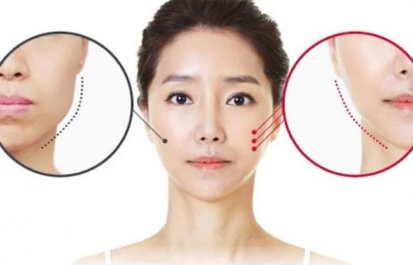 Phẫu thuật hàm khắc phục mặt lệch
