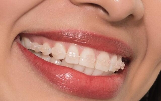 Người có gò má cao có thể lựa chọn phương pháp niềng răng nào?