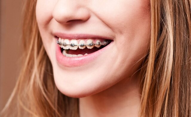 Chỉnh nha bằng kỹ thuật niềng răng có hỗ trợ hạ gò má không?