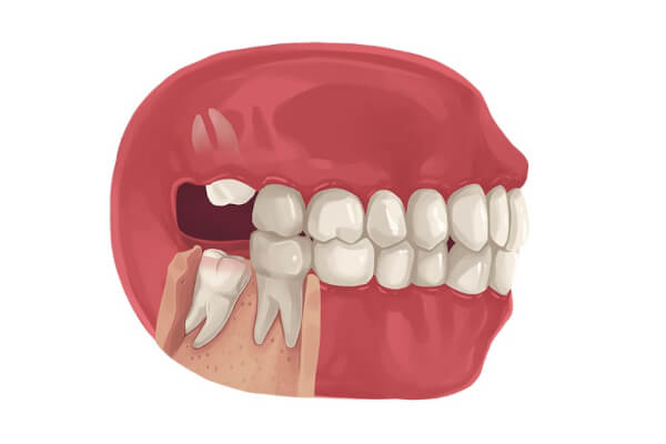 Giới thiệu sơ lược về răng khôn là gì