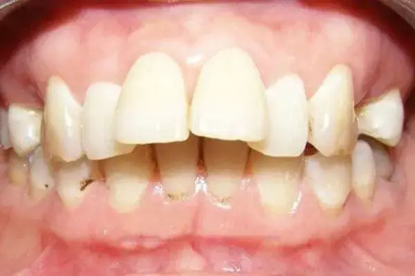 Răng bị chìa xuất phát từ nhiều nguyên nhân khác nhau